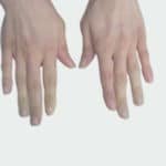 Sjogren’s Syndrome